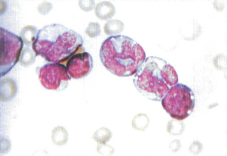 图4-9 单核细胞性白血病血像